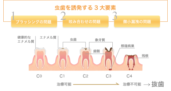 虫歯を誘発する三大要素
