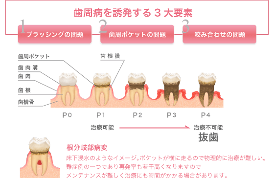歯周病を誘発する三大要素